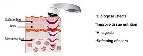 Ultrasound Therapy Device